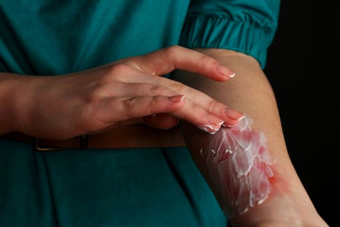 kem bôi trị bỏng dầu ăn